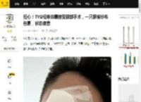 担心！TVB视帝自曝接受眼部手术，一只眼被纱布包裹，状态疲惫_陈山聪_眼睛_情况